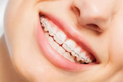 牙齿矫正的时间要多久？跟传统矫正和隐形矫正有关系吗？