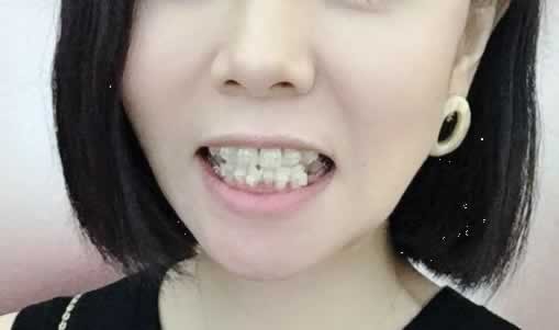 我38岁开始整牙，因为我想让自己变得更美一些。