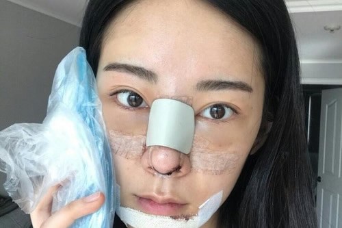 膨体隆鼻做完之后变化大吗？看看真实案例吧