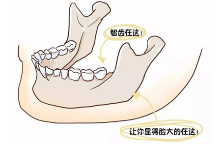 智齿拔掉后有什么副作用吗？