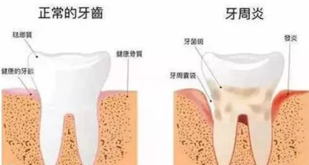 早期牙周炎有什么症状？