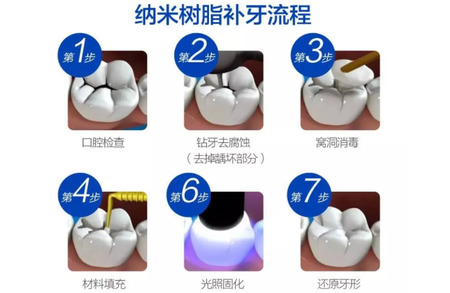 补牙后一般能维持几年?