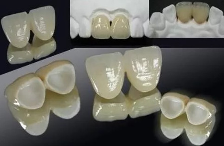 烤瓷牙多少钱一颗？贵不贵？