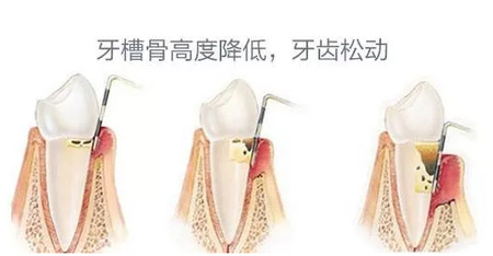 牙齿松动是什么情况？