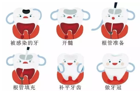 根管治疗后为什么要做牙冠？