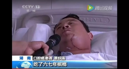 你是口腔癌高危人群吗？
