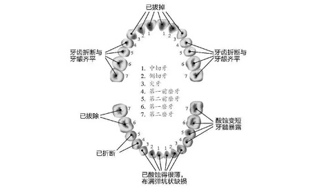 常喝软饮，等于把牙齿泡在酸液里
