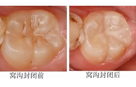 什么时候该做窝沟封闭？