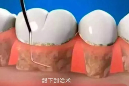 「治不好」的牙周炎