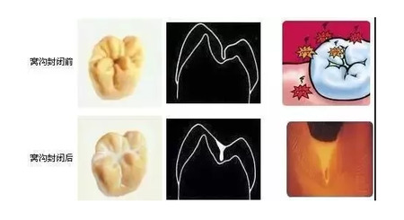 窝沟封闭的概念