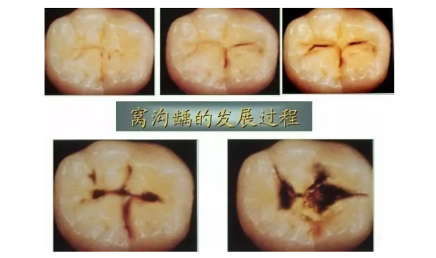 牙齿有黑线又怎样？不疼不痒又没事？