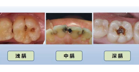 我和我的孩子上都有黑线，孩子的预防完了，我该怎么办？