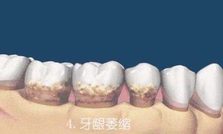 牙龈萎缩可以恢复吗？