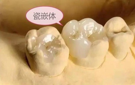 补牙的时候有什么是要注意的？要注意的事情有哪些？