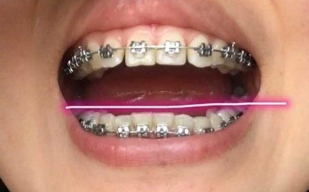 牙齿正畸的并发症有哪些？