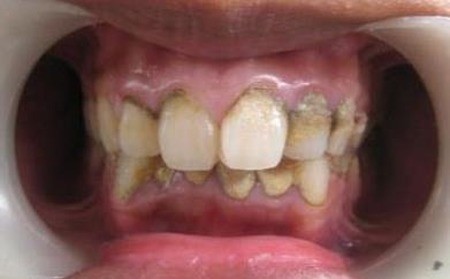 牙结石怎么形成的？