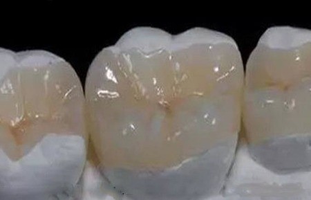 补牙用什么材料？