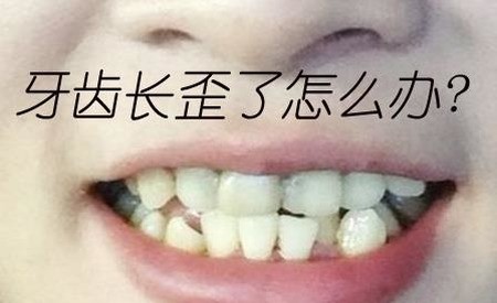 小孩牙长歪了怎么办啊？