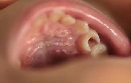 蛀牙补牙后能维持多久？