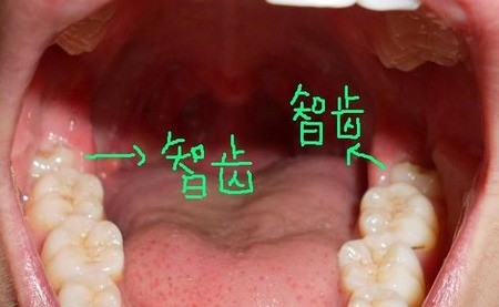 智齿不歪需要拔掉吗？