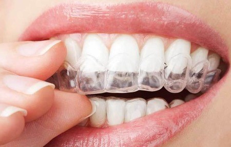 正畸为什么要拔牙？