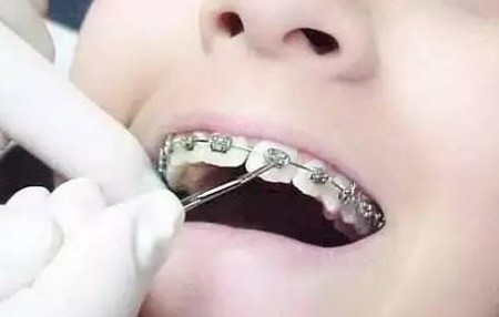 传统的钢丝牙套好吗？