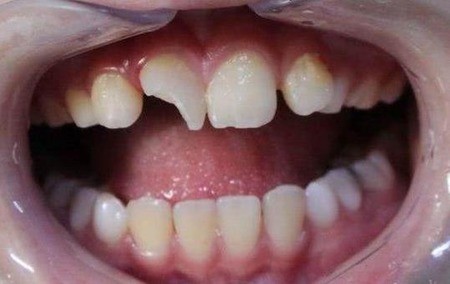 牙齿断裂会自动修复吗？