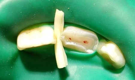 断牙神经线有什么后果？