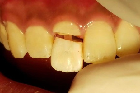 带牙套后牙根断怎么办？