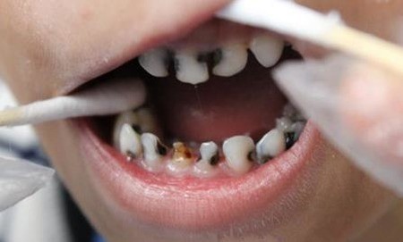如何预防儿童龋齿的发生？