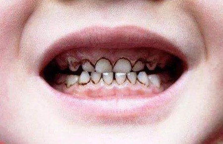 儿童患龋齿是否需要治疗？