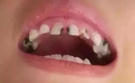 该如何预防儿童龋齿？