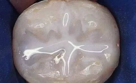 怎么样才能防止蛀牙？