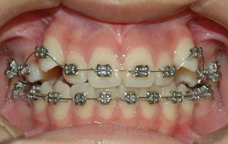 矫正牙齿后怎么刷牙？