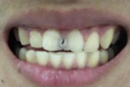 补完门牙后要注意什么？