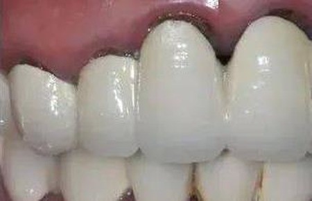 全瓷牙修复的注意事项有哪些？