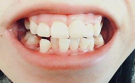 正畸治疗初期疼痛不适如何缓解？