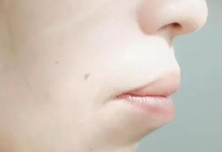 牙性龅牙怎么治疗？