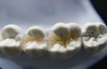 树脂补牙牢固吗？
