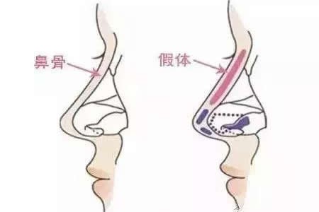 鼻综合手术后饮食推荐？