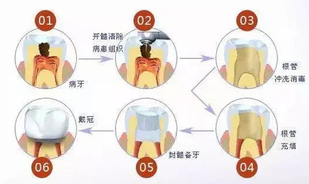 根管治疗是什么？