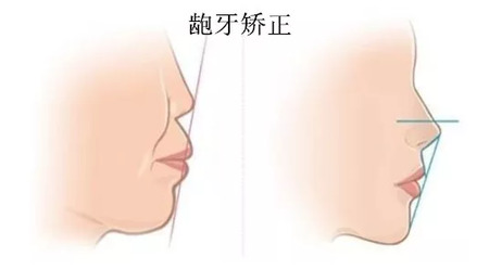 整牙到底能不能瘦脸？