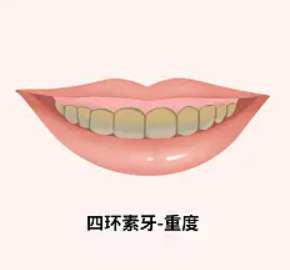 廊坊管道局医院能做双眼皮吗？附上手术术后果图分享！